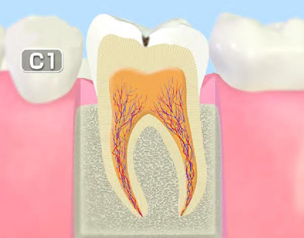 初期のむし歯(C1)