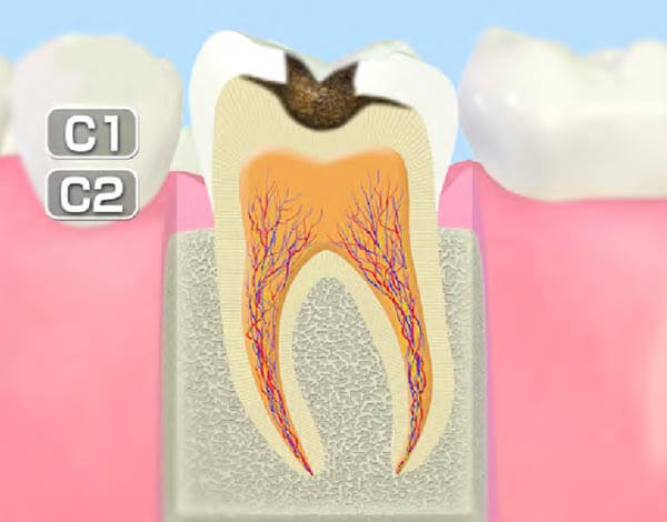 進行したむし歯(C2)