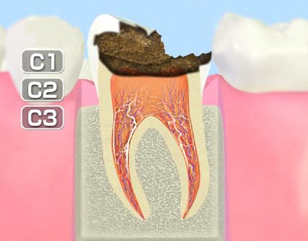 歯髄まで進行したむし歯 (C3)