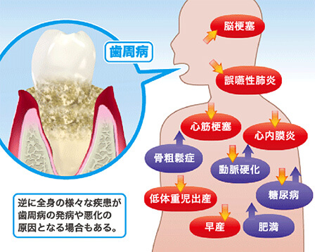 むし歯の発生要因と対策