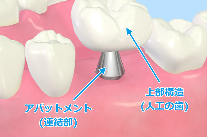 インプラント2次手術