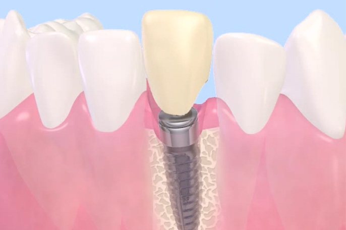 インプラント治療